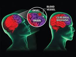 Concussion Information
